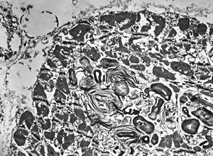 M,45y. | Fabry disease - myocardium